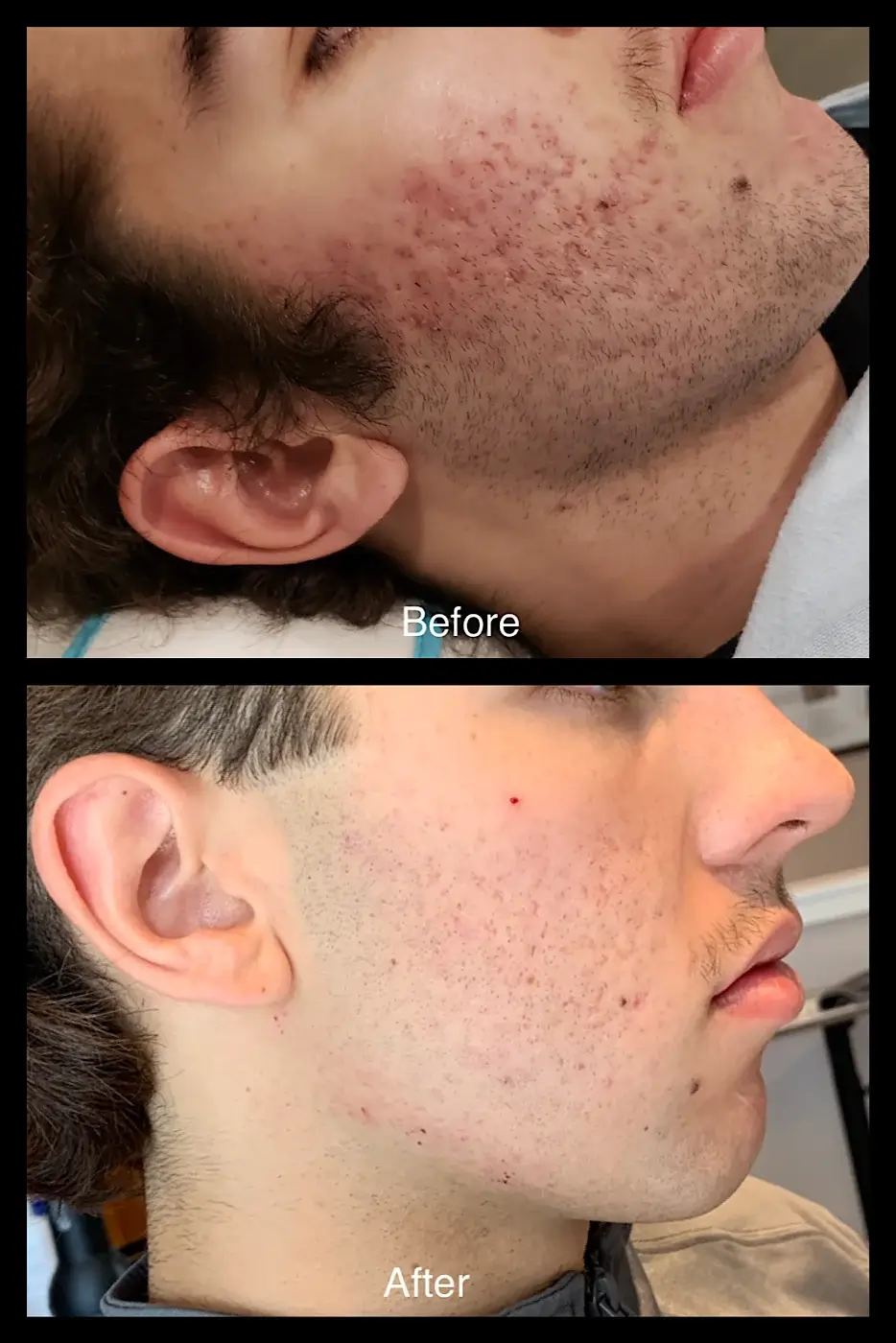 Acne-Skin-Transformation